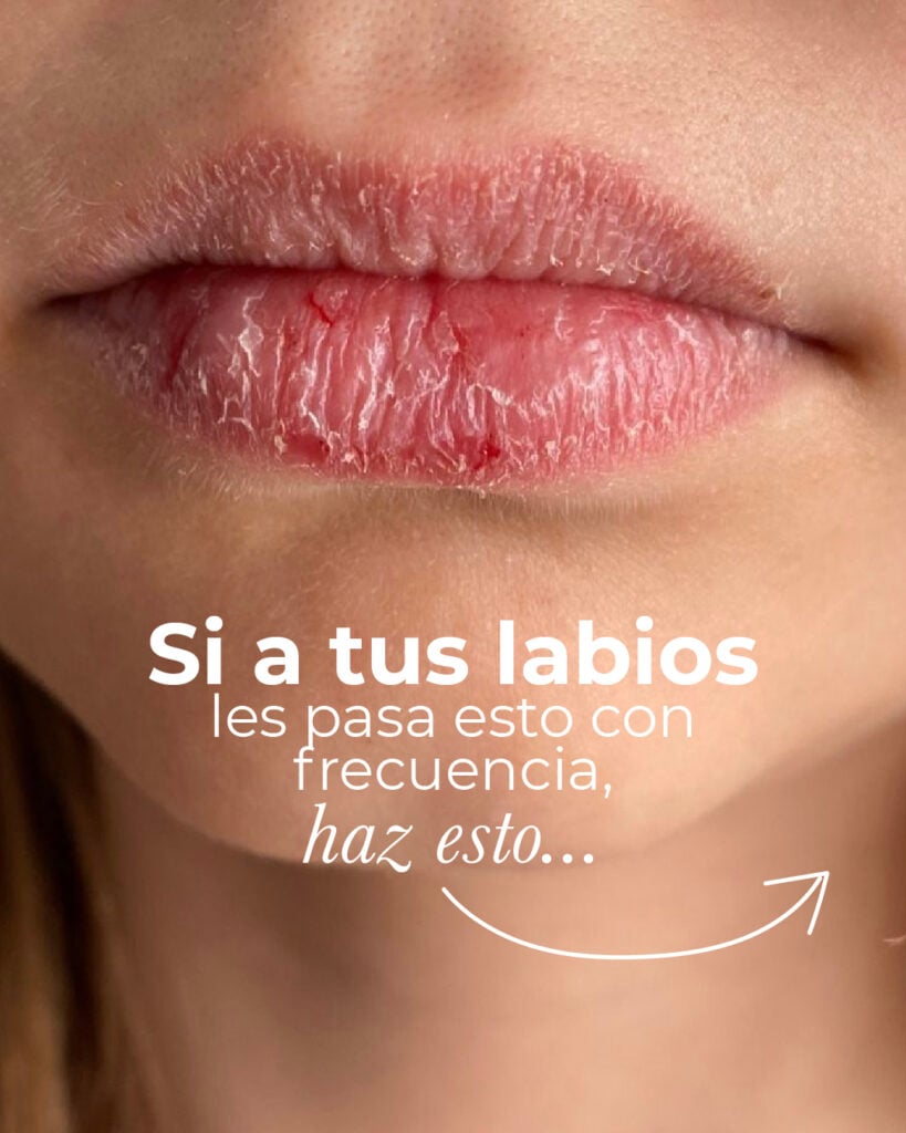 Imagen de labios resecos y rotos con un texto de invitación a conocer como cuidar tus labios