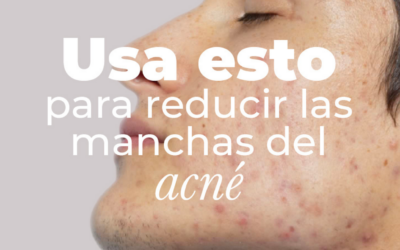 Acné de adulto: ingredientes clave para mejorar las marcas en la piel